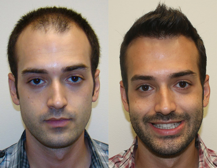 Antes y después con MÓKAVICH® FORTE 5%